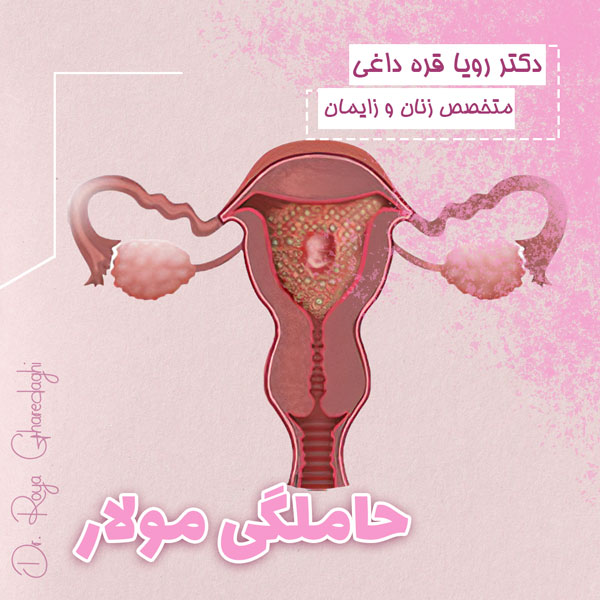 حاملگی مولار - دکتر قره داغی