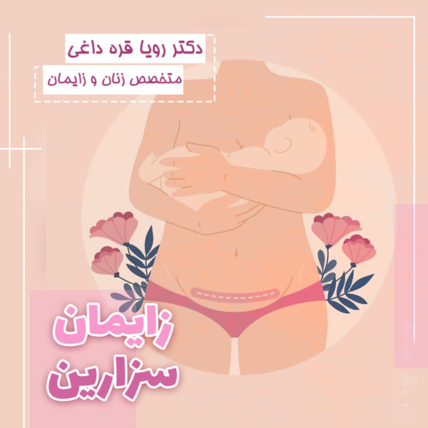 زایمان سزارین - دکتر رویا قره داغی