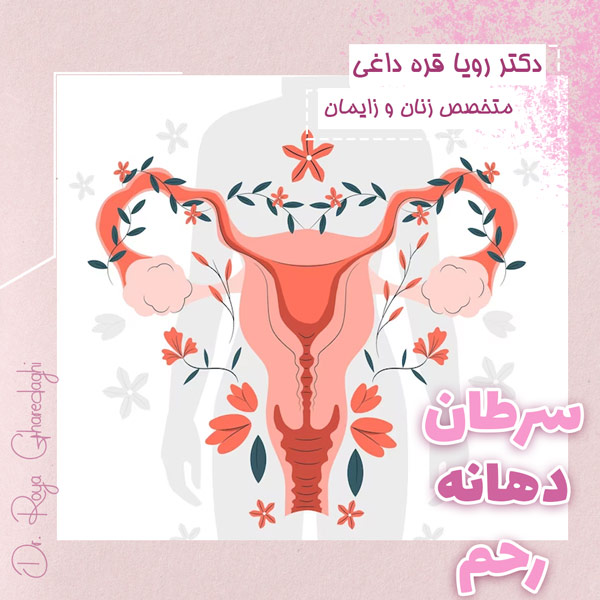سرطان دهانه رحم - دکتر قره داغی