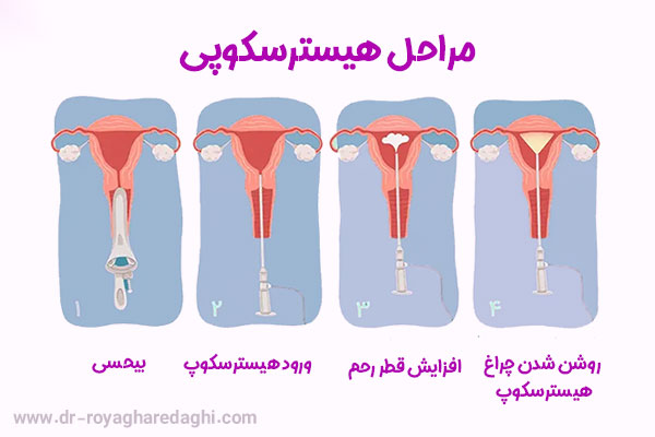 هیستروسکوپی - دکتر رویا قره داغی