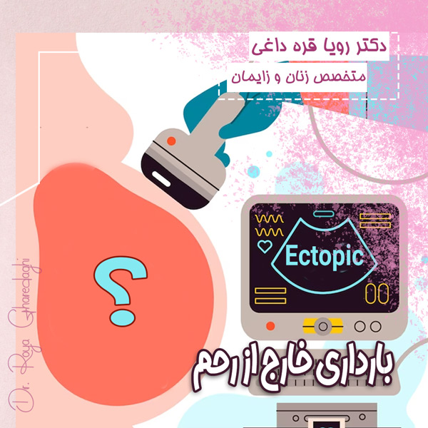 بارداری خارج از رحم-دکتر رویا قره داغی