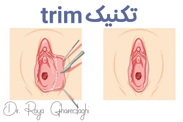 عکس قبل و بعد لابیاپلاستی