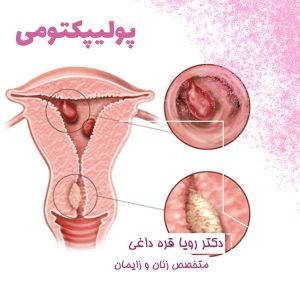 پولیپکتومی + دکتر رویا قره داغی-dr-royagharedaghi.com