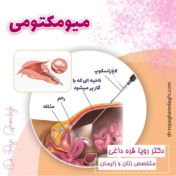 میومکتومی + دکتر رویا قره داغی