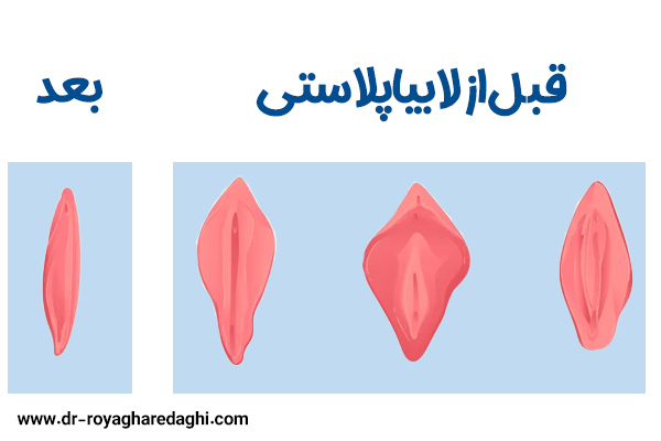 عکس قبل و بعد لابیاپلاستی