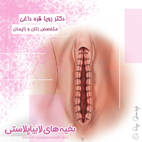 بخیه های لابیاپلاستی - https://dr-royagharedaghi.com/