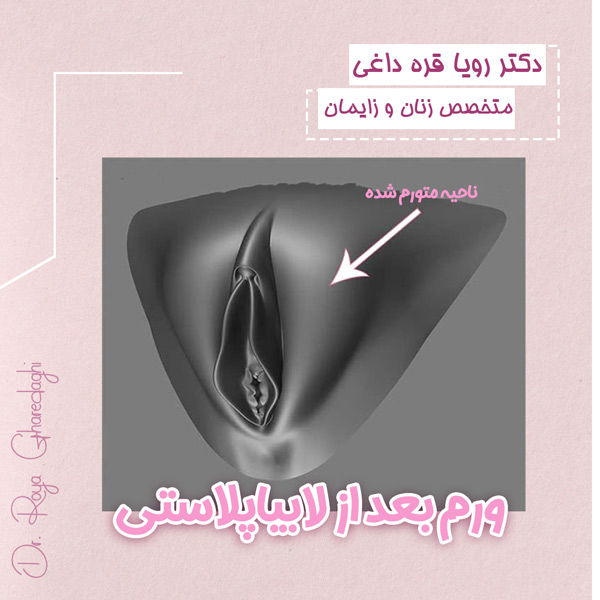 ورم بعد از لابیاپلاستی - https://dr-royagharedaghi.com/