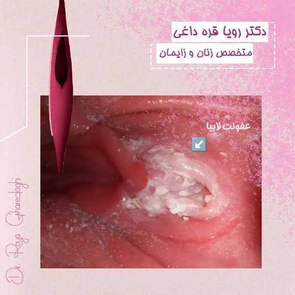 عکس عفونت بعد از لابیاپلاستی