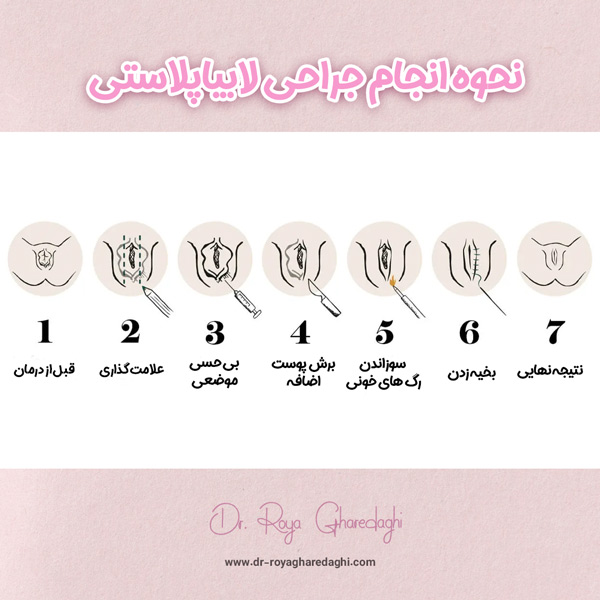 عکس مراحل انجام لابیاپلاستی 