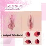 خونریزی بعد از لابیاپلاستی + 6 علت اصلی خونریزی + درمان