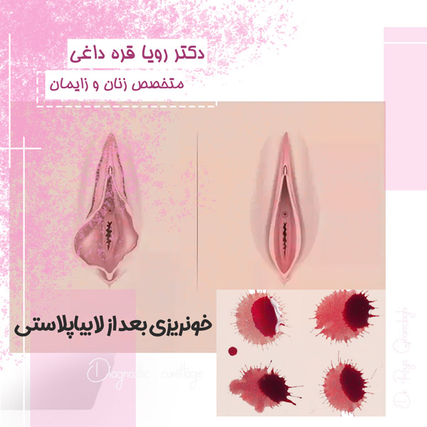 خونریزی بعد از لابیاپلاستی