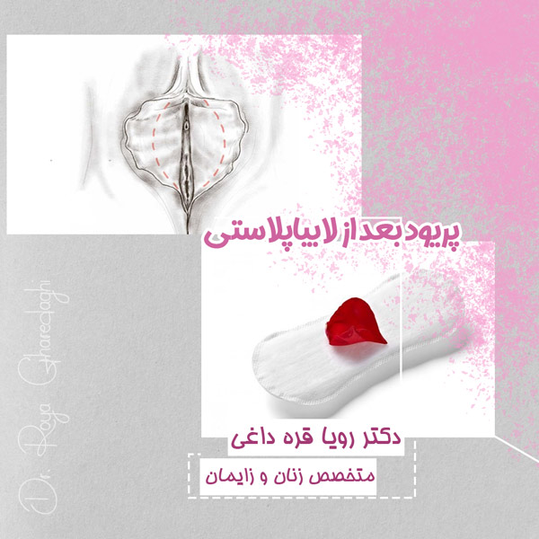 پریود بعد از لابیاپلاستی