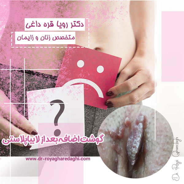 گوشت اضافه بعد از لابیاپلاستی