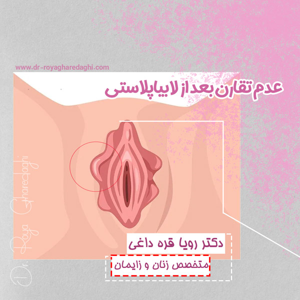 عدم تقارن بعد از لابیاپلاستی