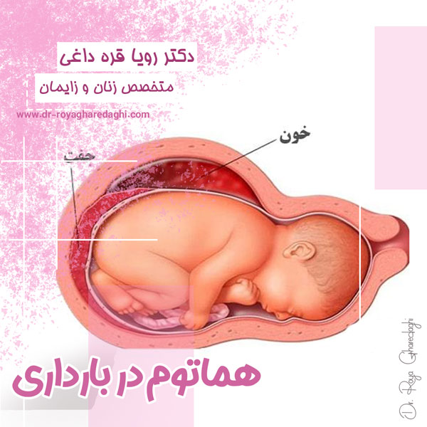 هماتوم در بارداری