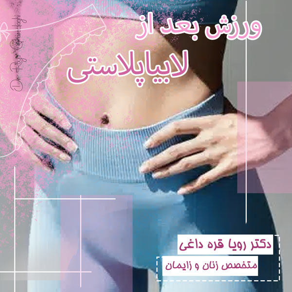ورزش بعد از لابیاپلاستی - دکتر رویا قره داغی - dr-royagharedaghi.com