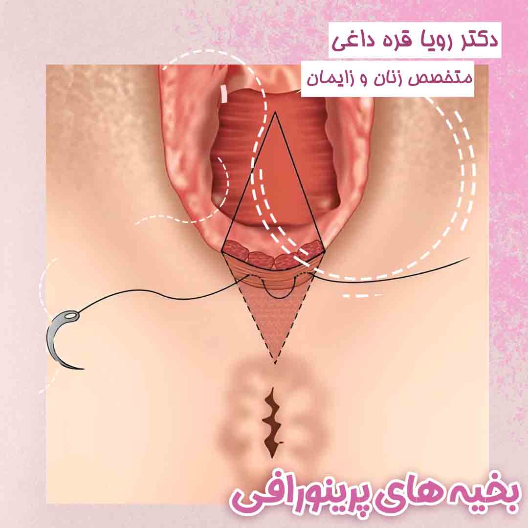 بخیه های پرینورافی